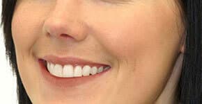 After Dental Procedure