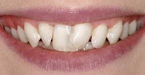 Before Dental Procedure
