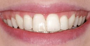 After Dental Procedure