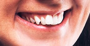 Before Dental Procedure