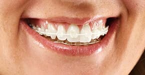 Before Dental Procedure