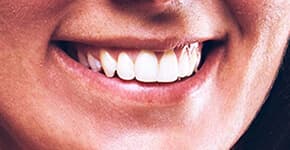 After Dental Procedure
