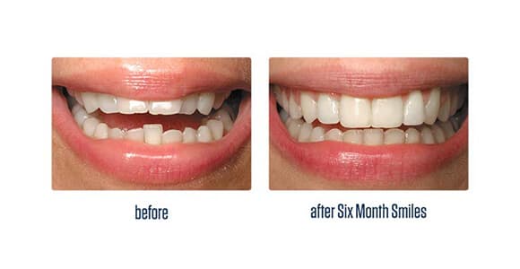 Before Dental Procedure
