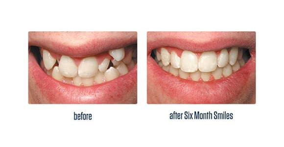 Before Dental Procedure