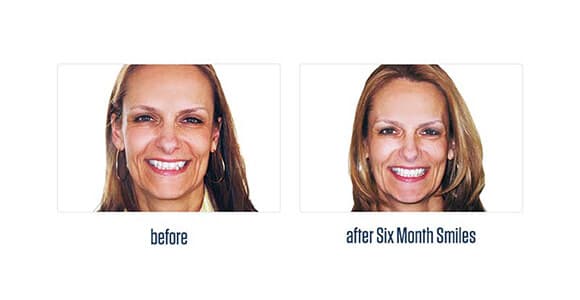 Before Dental Procedure