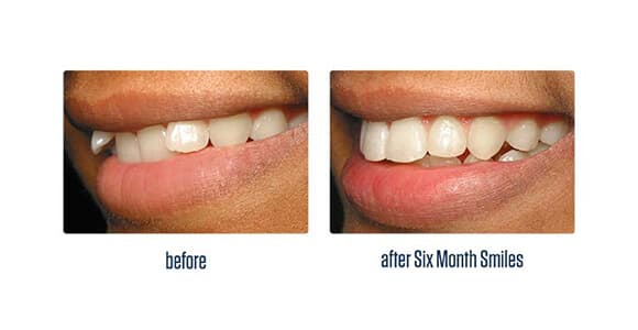 Before Dental Procedure