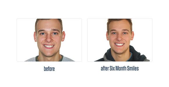 Before Dental Procedure