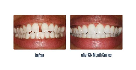 Before Dental Procedure