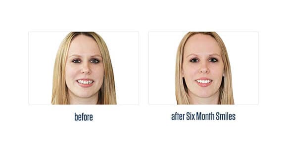 Before Dental Procedure