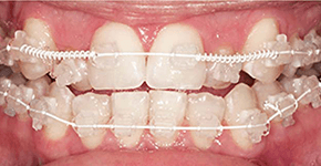 Before Dental Procedure