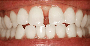 After Dental Procedure