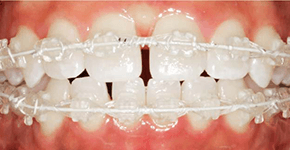 Before Dental Procedure