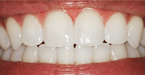 After Dental Procedure