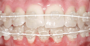 Before Dental Procedure